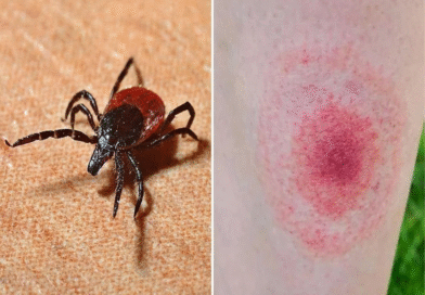 La amenaza silenciosa de Lyme, la enfermedad que transmiten las garrapatas.
